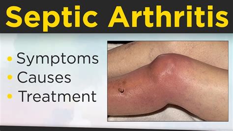 MRSA Septic Arthritis