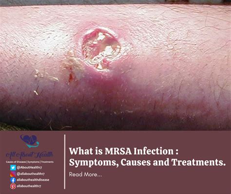 MRSA skin infection signs