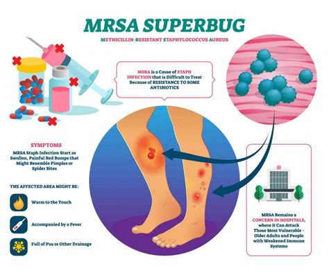 MRSA Symptoms Image