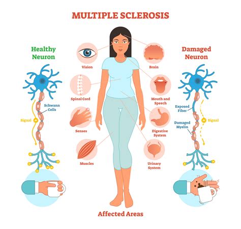 Understanding Multiple Sclerosis