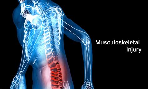 Supporting soldiers with musculoskeletal injuries