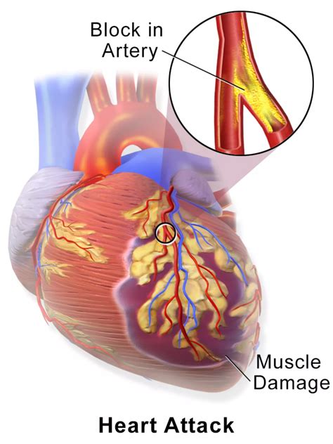 Myocardial infarction