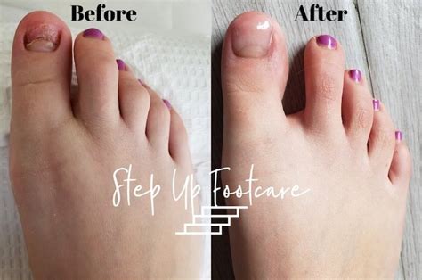 Nail Repair and Restoration