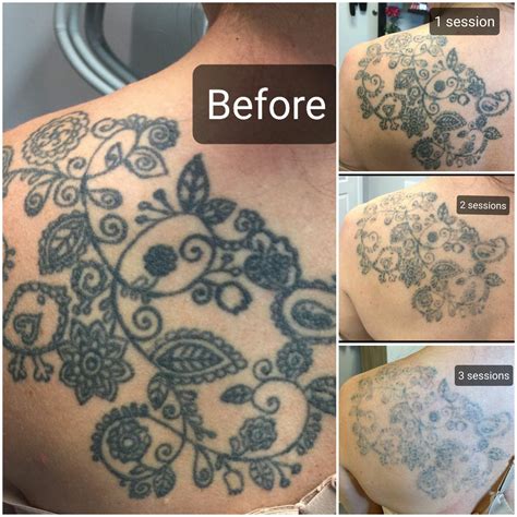 Nashville tattoo removal