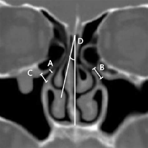 Natural Infundibulum Example