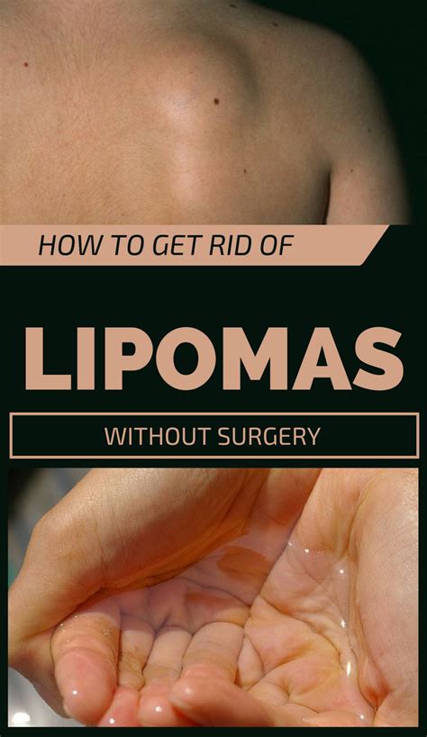 Natural Lipoma Treatments Overview