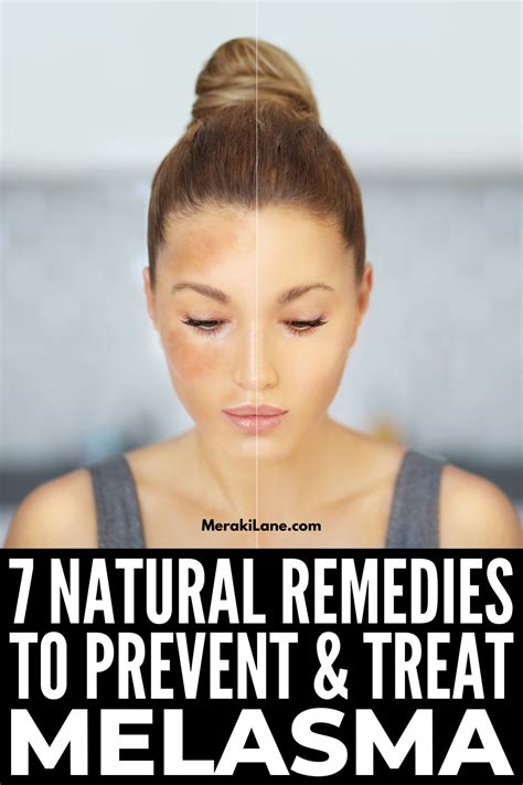 Natural Remedies for Melasma