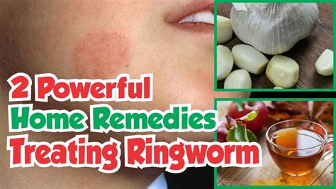 Natural remedies for ringworm