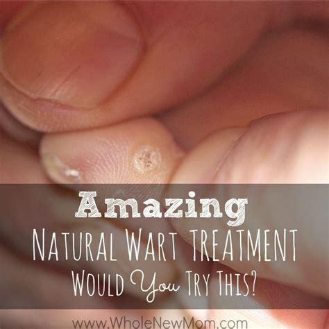 Natural remedies for warts