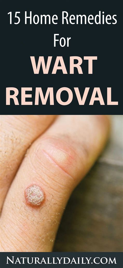 Natural wart treatment