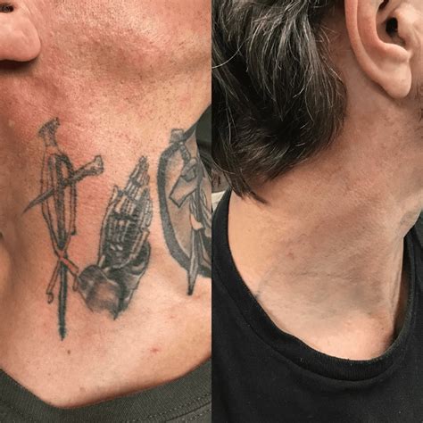 Neck tattoo removal