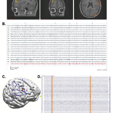 Neuro Mag Results