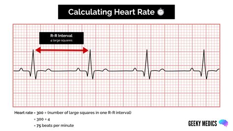 Normal EKG interpretation