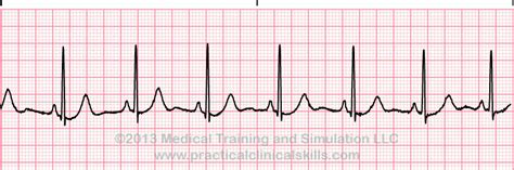 Normal Sinus Rhythm EKG