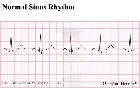 Normal sinus rhythm EKG interpretation