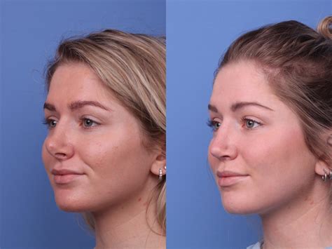 Nose surgery procedure