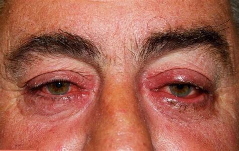 Ocular Rosacea Symptoms