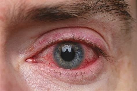 Ocular Rosacea Treatment and Management