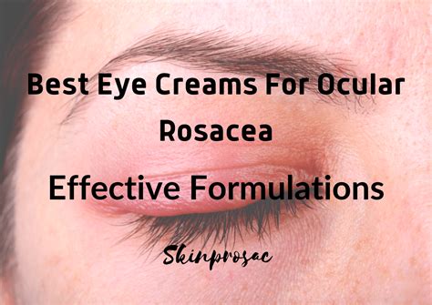 Ocular Rosacea Treatment