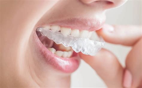 Orthodontist Invisalign