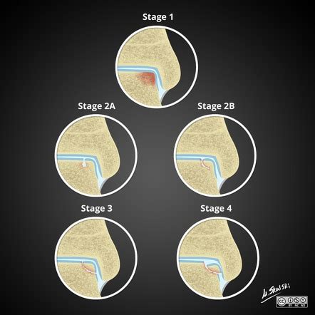 Osteochondral Lesion