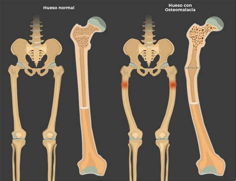 Osteomalacia