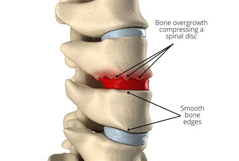 Osteophyte Formation