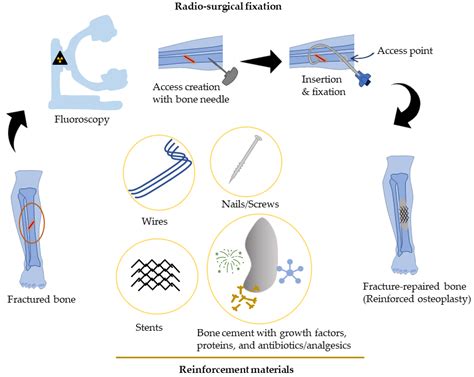 Osteoplasty and Regenerative Medicine