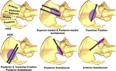 Osteoplasty for Functional Improvement