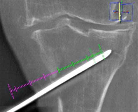 Osteoplasty Outcomes