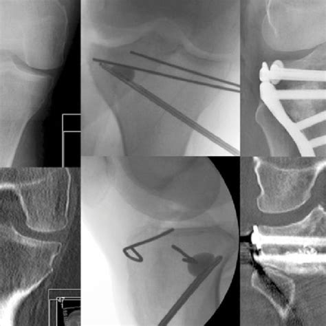 Osteoplasty Techniques and Methods