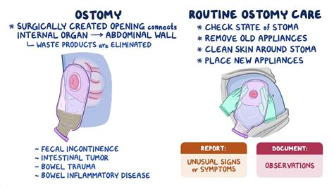 Ostomy Care Nursing Skills Gallery 2