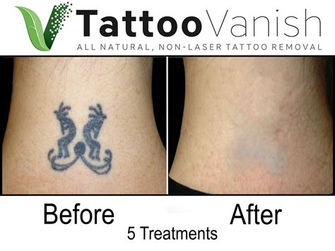 Other tattoo removal methods in Louisville