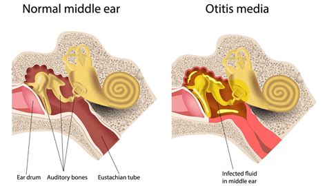 Description of Otitis Media