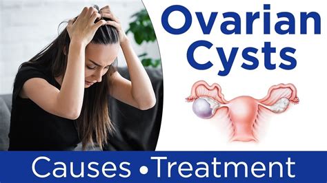 Ovarian Cyst Treatment