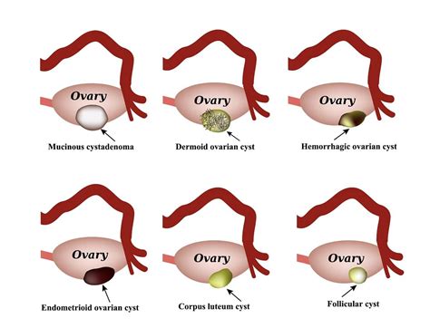 Ovarian Cysts