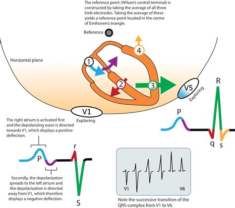 P-wave EKG interpretation