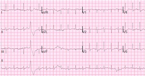 Paroxysmal Atrial Fibrillation Diagram