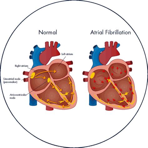 Paroxysmal Atrial Fibrillation Diagram