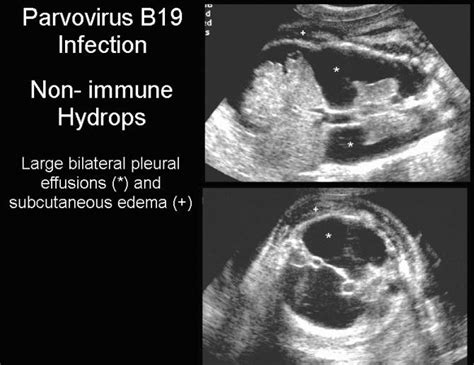 Effects of Parvovirus B19