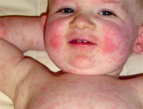 Parvovirus B19 Rash