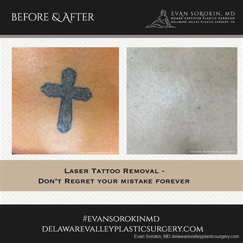 Philadelphia tattoo removal