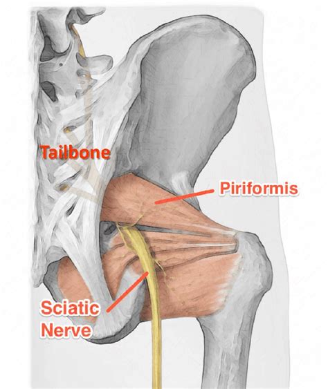 Piriformis syndrome diagram