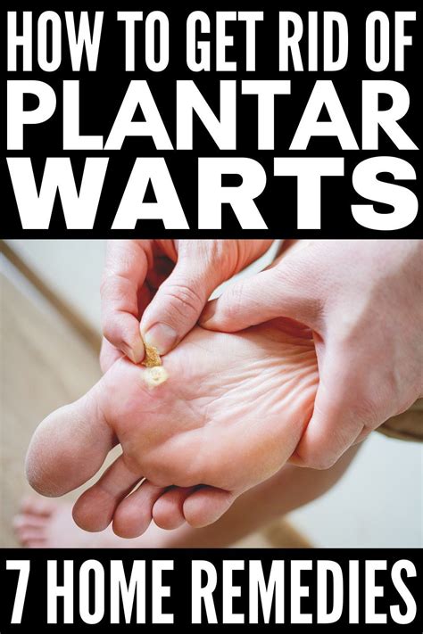 Plantar Wart Home Remedies