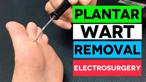 Plantar Wart Removal