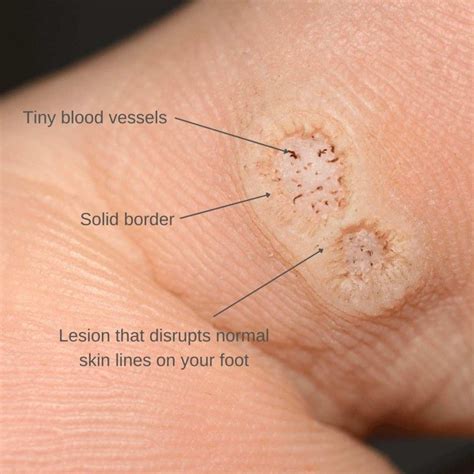 Plantar Wart Symptoms