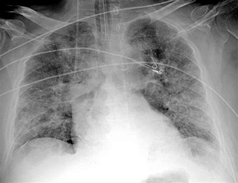 Pneumonia Imaging Test Image 9