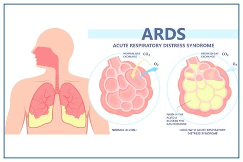 Pneumonia-Induced ARDS