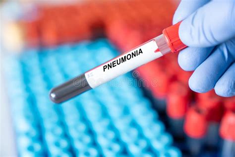 Pneumonia Laboratory Test Image 8