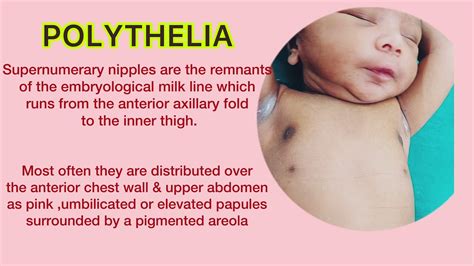 Description of Polythelia Symptoms